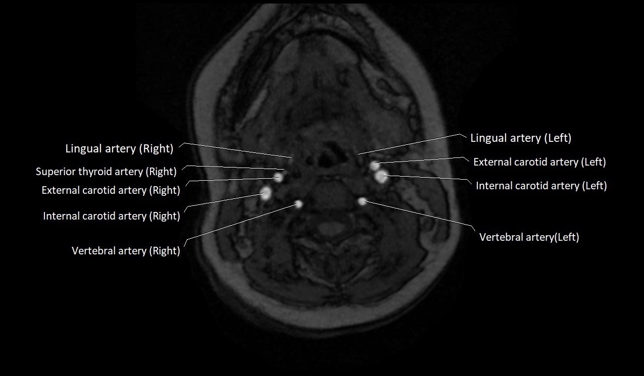 Carotid artery anatomy axial 3T image 26.jpg